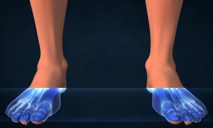 Calcium, Vitamin D and Stress Fractures