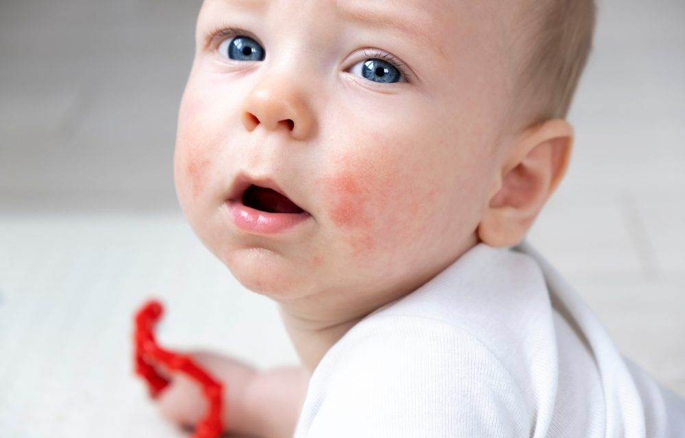 Can a Mother’s Gut Health Protect Her Child’s Skin?