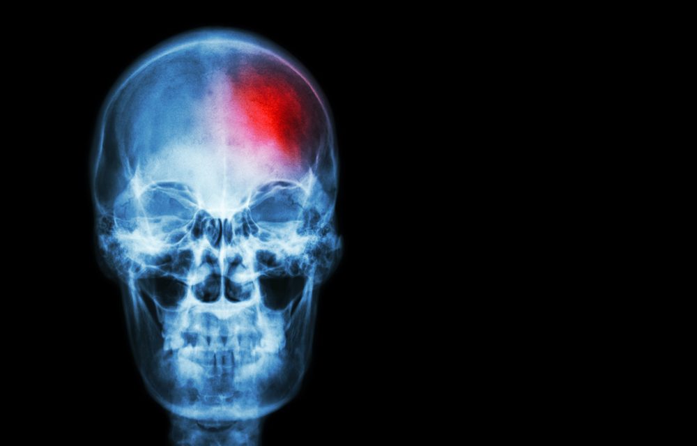 Will this Vitamin Help With Stroke Prevention?