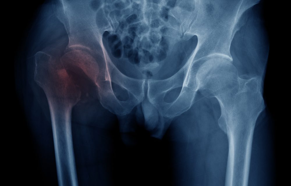Calcium for Protecting Bone may not be all that it is Cracked up to Be