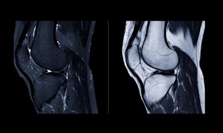 How Cartilage Works—And Why Joints Degenerate With Age