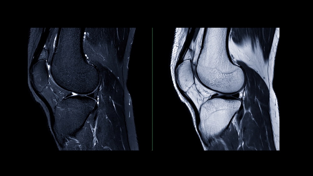 How Cartilage Works—And Why Joints Degenerate With Age