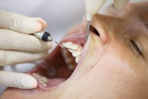 Vitamin C and Periodontal Disease