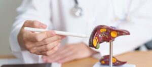 Doctor using a pointer to explain fatty liver disease on a detailed liver model.