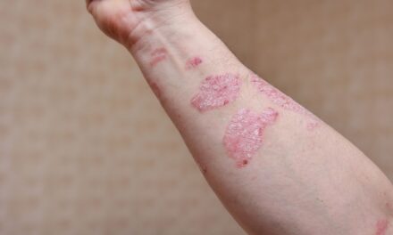 “Nutrition and Psoriasis: How Vitamin D, Fish Oil, Gluten-Free Diets, and B-Vitamins May Help”