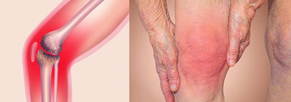 Niacinamide for Joint Pain and Mobility