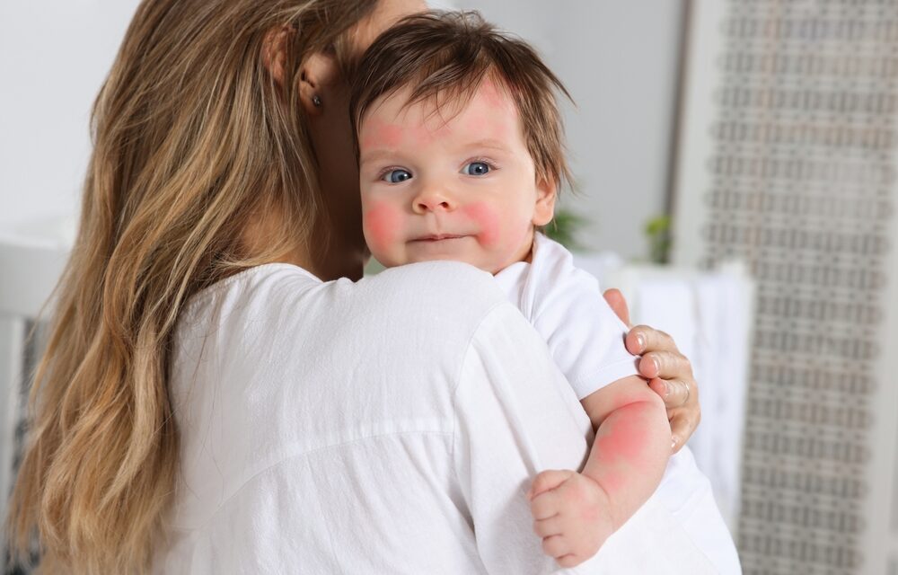 If Your Baby Has Eczema, Try This