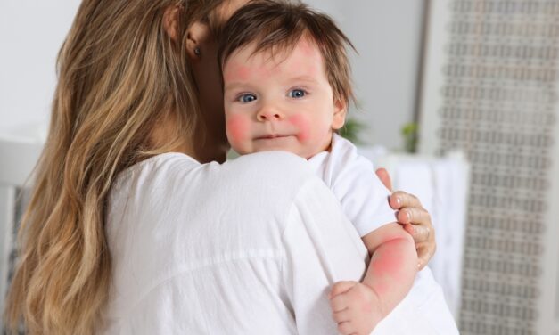 If Your Baby Has Eczema, Try This